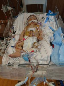 Reed after his first heart surgery. Source: Family photo